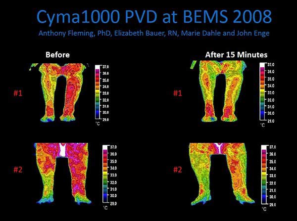 Cymatherapy Inflammation Decrease in Legs Chicago IL