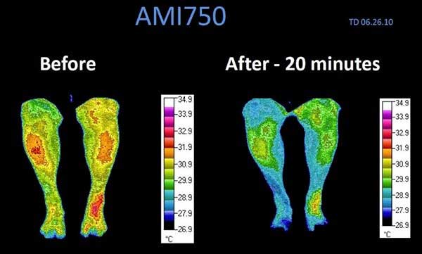 Cymatherapy Decreases Inflammation in Legs Chicago IL